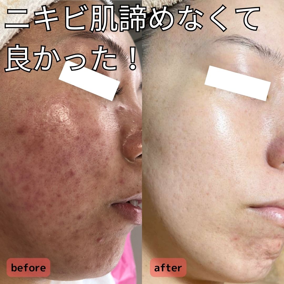 フェイスラインのニキビは内臓の不調かも？/Is Jawline Acne a Sign of Internal Issues?